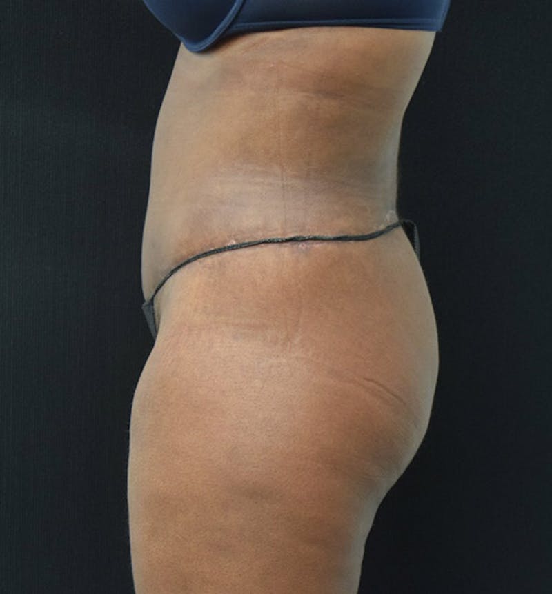 Lower Body Lift Before & After Gallery - Patient 102423515 - Image 10
