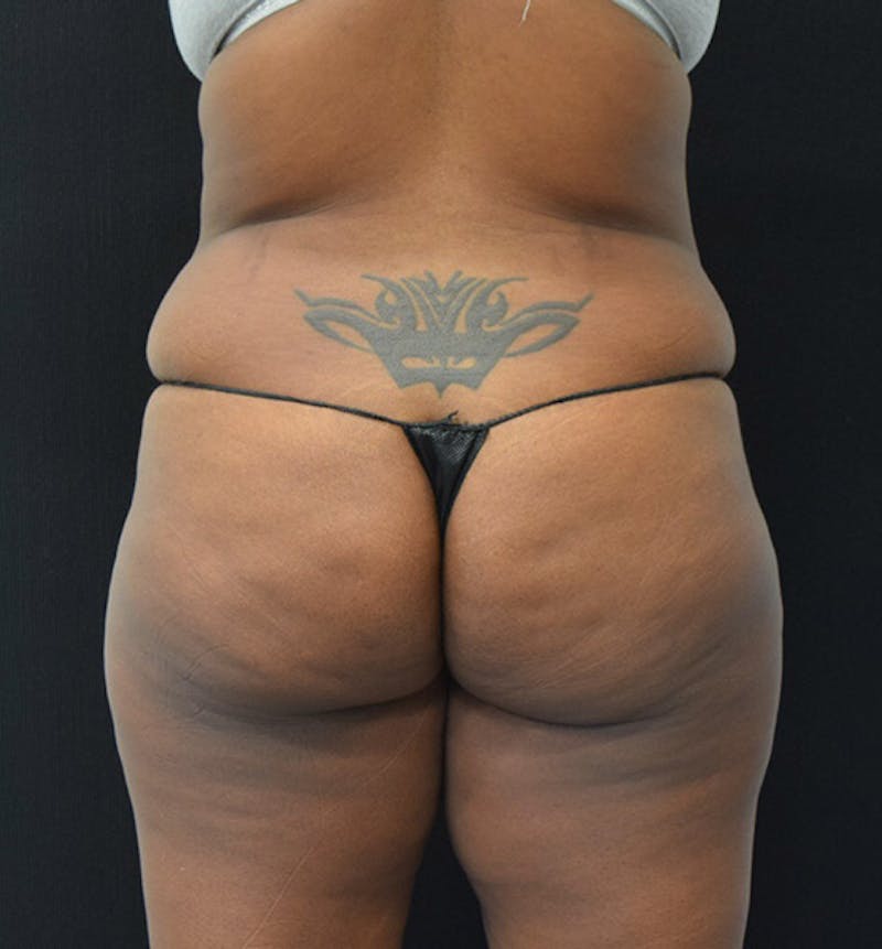 Lower Body Lift Before & After Gallery - Patient 102423515 - Image 11