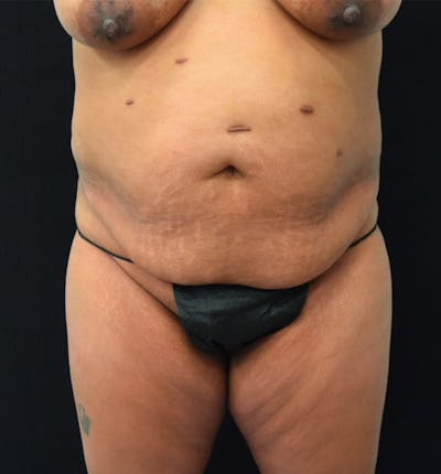 Lower Body Lift Before & After Gallery - Patient 102423734 - Image 1