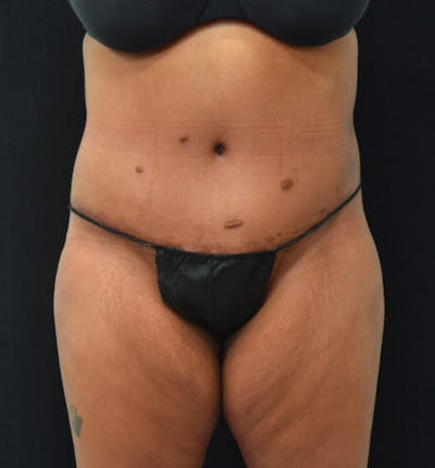 Lower Body Lift Before & After Gallery - Patient 102423734 - Image 2