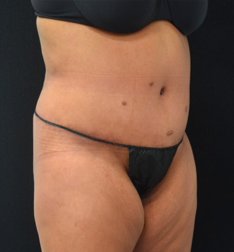 Lower Body Lift Before & After Gallery - Patient 102423734 - Image 4