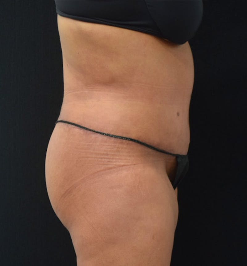 Lower Body Lift Before & After Gallery - Patient 102423734 - Image 6
