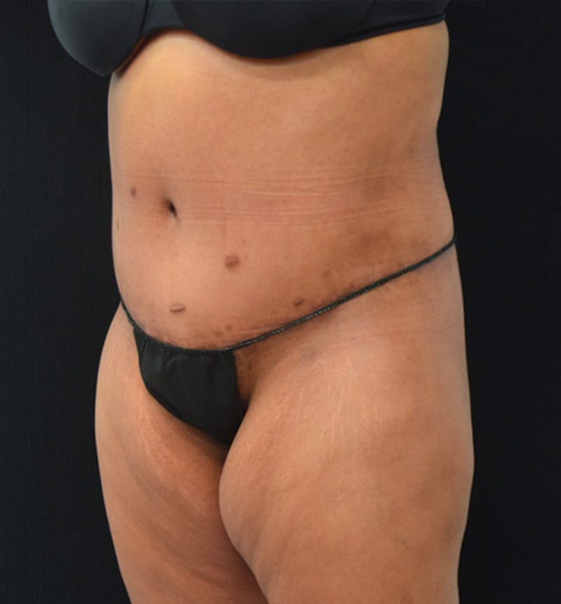 Lower Body Lift Before & After Gallery - Patient 102423734 - Image 8