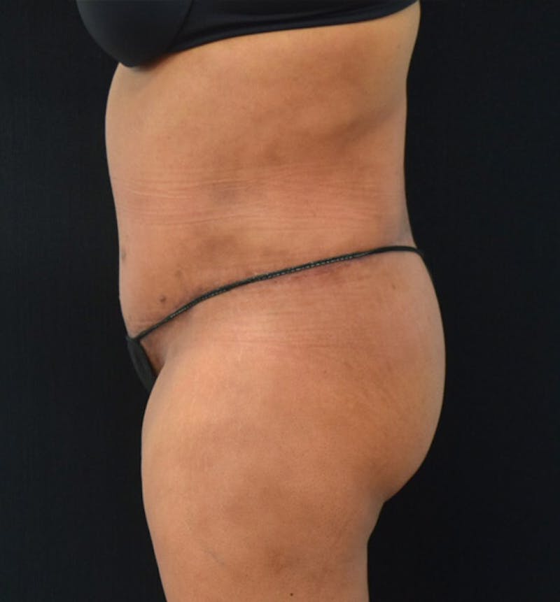 Lower Body Lift Before & After Gallery - Patient 102423734 - Image 10