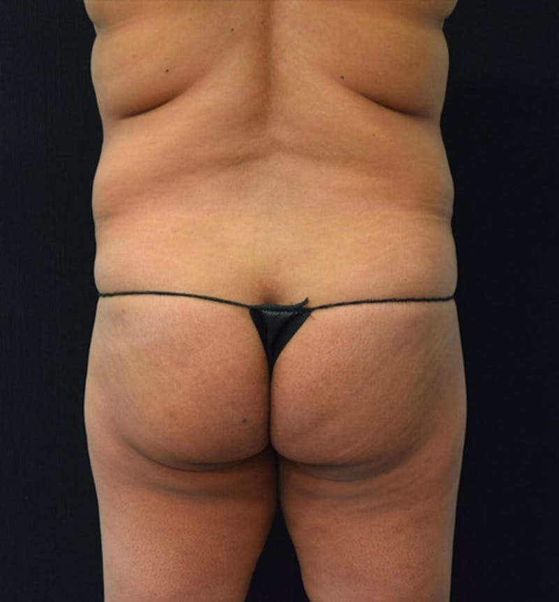 Lower Body Lift Before & After Gallery - Patient 102423734 - Image 11
