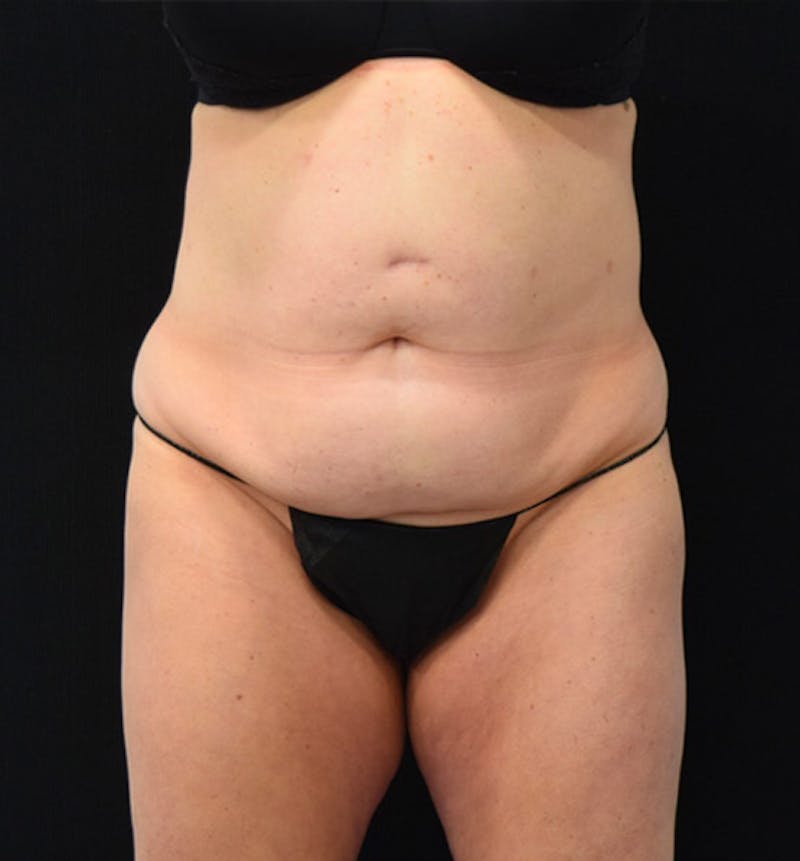 Lower Body Lift Before & After Gallery - Patient 102423898 - Image 1