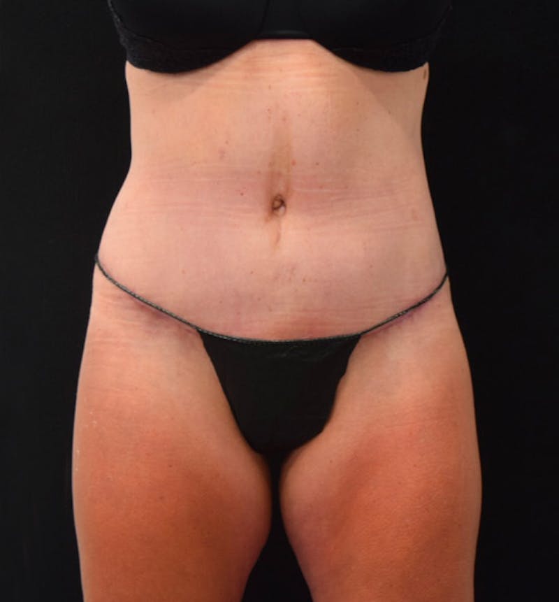 Lower Body Lift Before & After Gallery - Patient 102423898 - Image 2