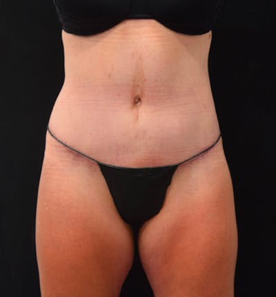 Lower Body Lift Before & After Gallery - Patient 102423898 - Image 2