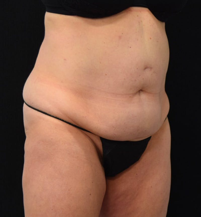 Lower Body Lift Before & After Gallery - Patient 102423898 - Image 3