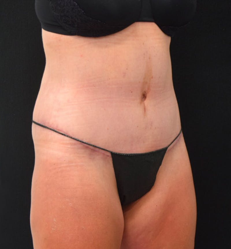 Lower Body Lift Before & After Gallery - Patient 102423898 - Image 4