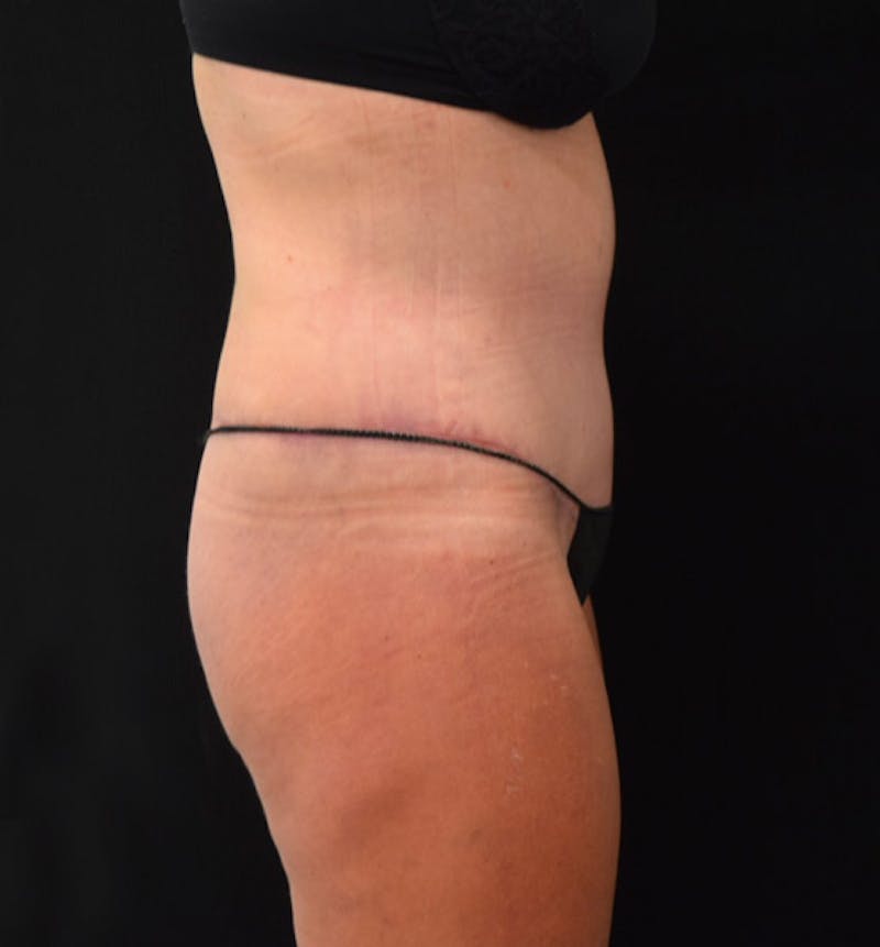 Lower Body Lift Before & After Gallery - Patient 102423898 - Image 6