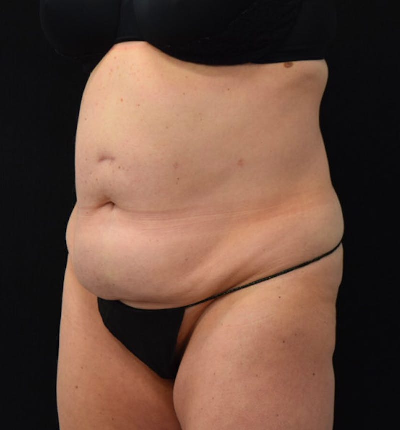 Lower Body Lift Before & After Gallery - Patient 102423898 - Image 7
