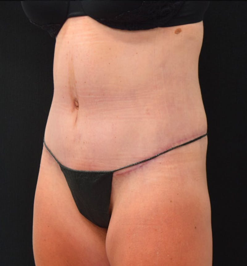 Lower Body Lift Before & After Gallery - Patient 102423898 - Image 8