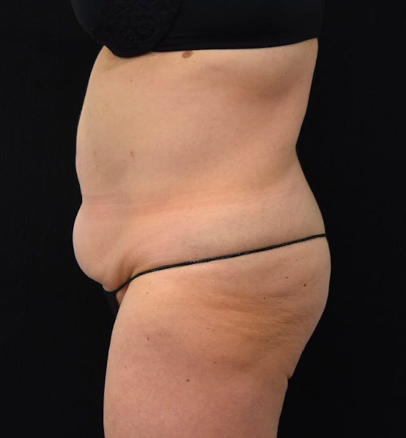 Lower Body Lift Before & After Gallery - Patient 102423898 - Image 9