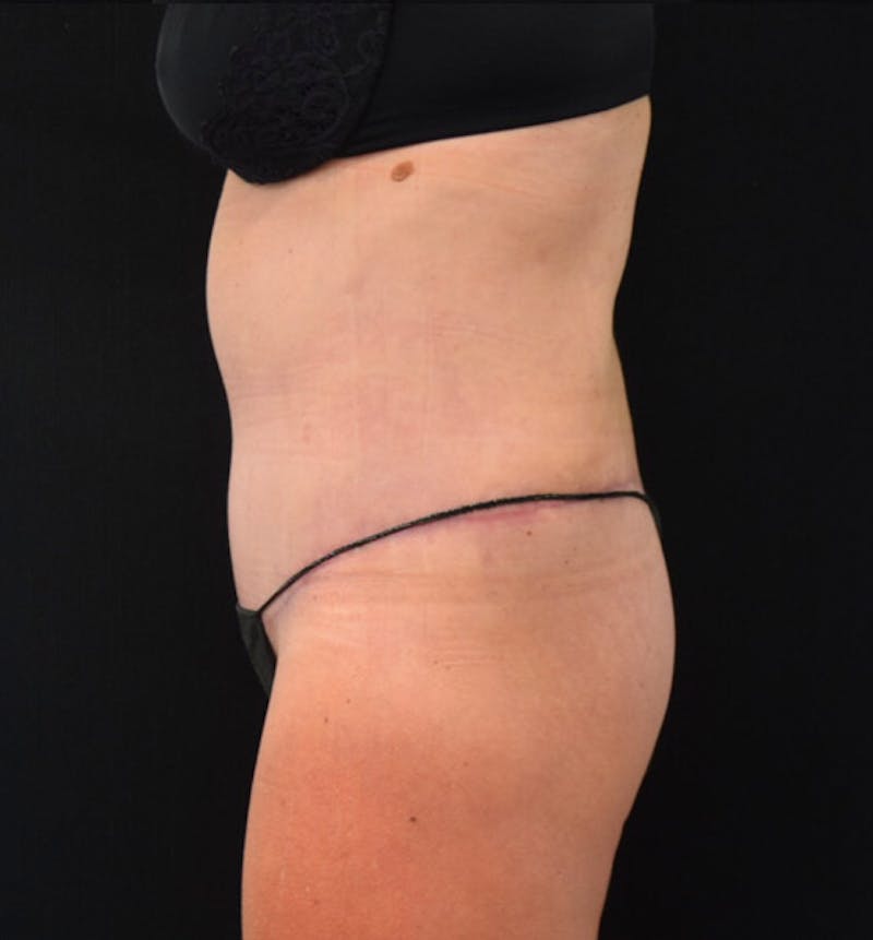 Lower Body Lift Before & After Gallery - Patient 102423898 - Image 10