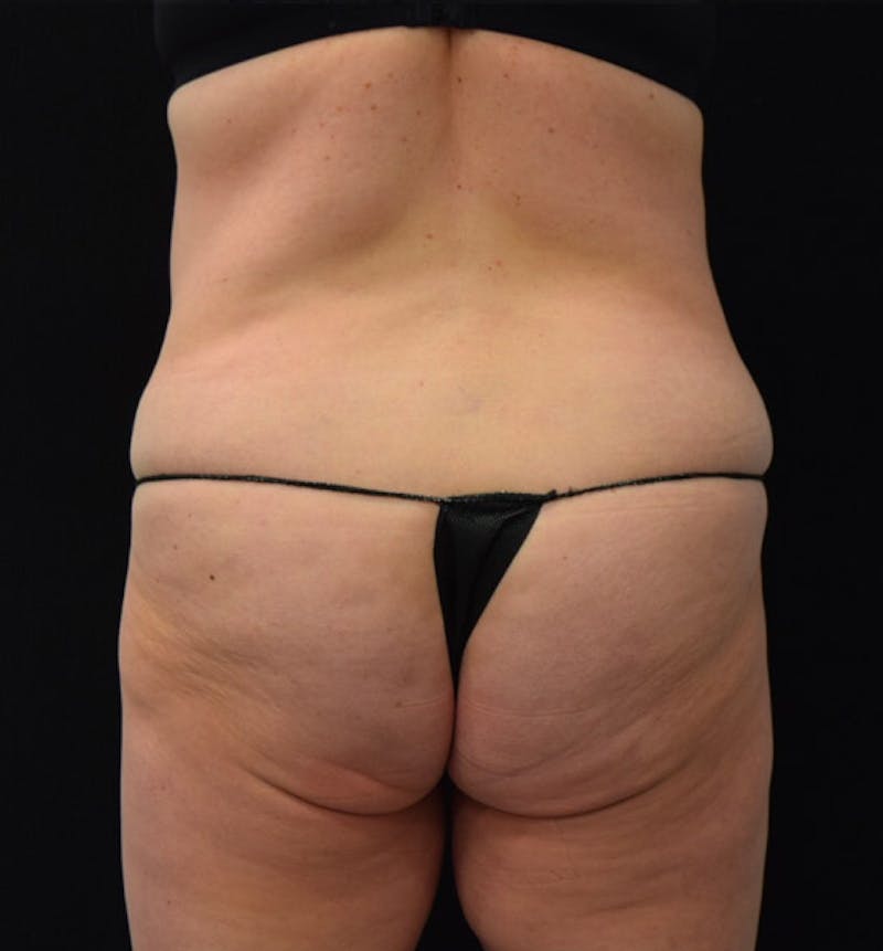 Lower Body Lift Before & After Gallery - Patient 102423898 - Image 11