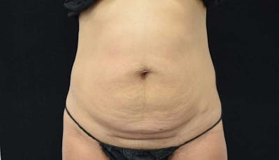 Abdominoplasty Before & After Gallery - Patient 102423917 - Image 1
