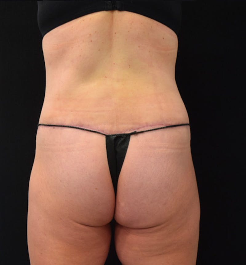 Lower Body Lift Before & After Gallery - Patient 102423898 - Image 12