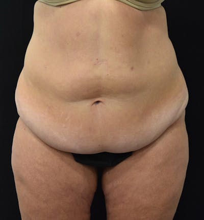 Lower Body Lift Before & After Gallery - Patient 102424241 - Image 1