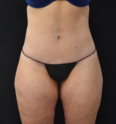 Lower Body Lift Gallery - Patient 102424241 - Image 2