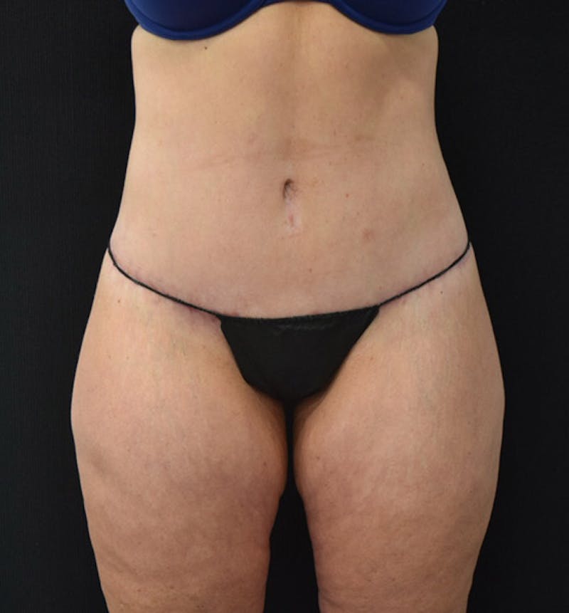 Lower Body Lift Before & After Gallery - Patient 102424241 - Image 2