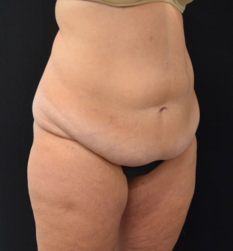 Lower Body Lift Before & After Gallery - Patient 102424241 - Image 3