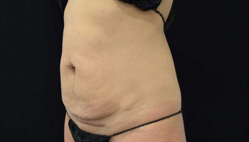 Abdominoplasty Before & After Gallery - Patient 102423917 - Image 3