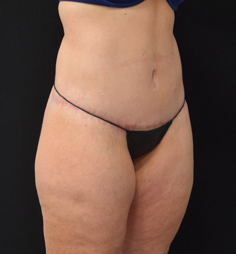 Lower Body Lift Before & After Gallery - Patient 102424241 - Image 4