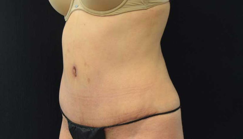 Abdominoplasty Before & After Gallery - Patient 102423917 - Image 4