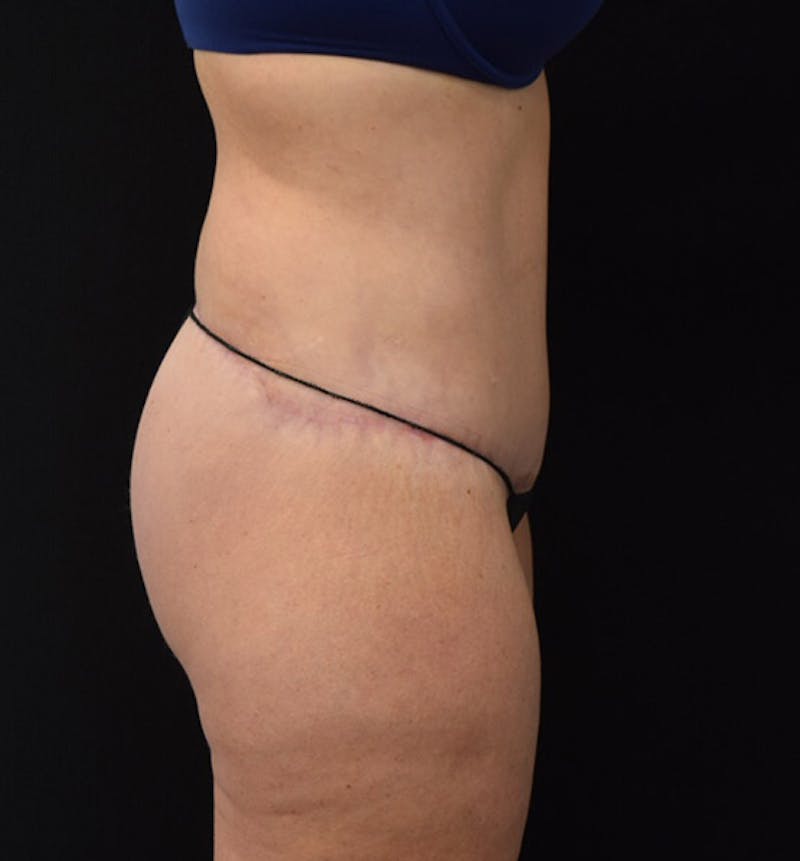 Lower Body Lift Before & After Gallery - Patient 102424241 - Image 6