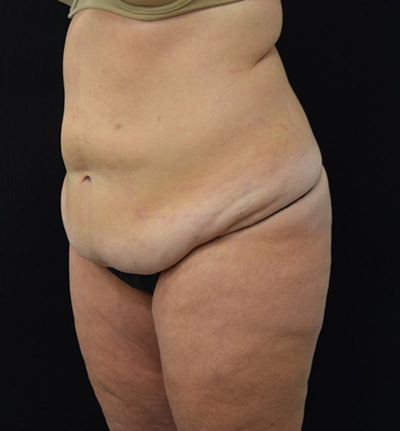 Lower Body Lift Before & After Gallery - Patient 102424241 - Image 7