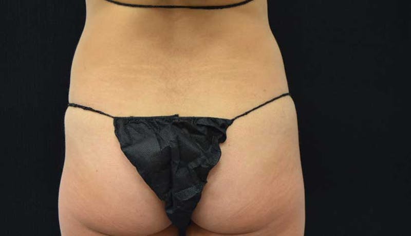 Abdominoplasty Before & After Gallery - Patient 102423917 - Image 5
