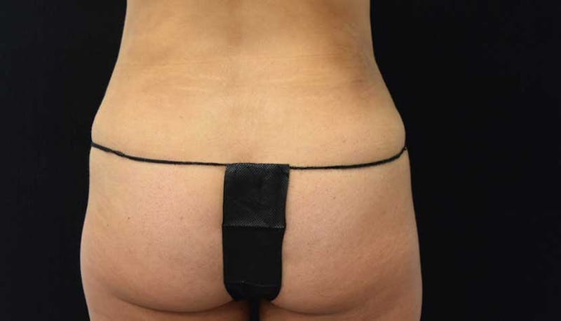 Abdominoplasty Before & After Gallery - Patient 102423917 - Image 6