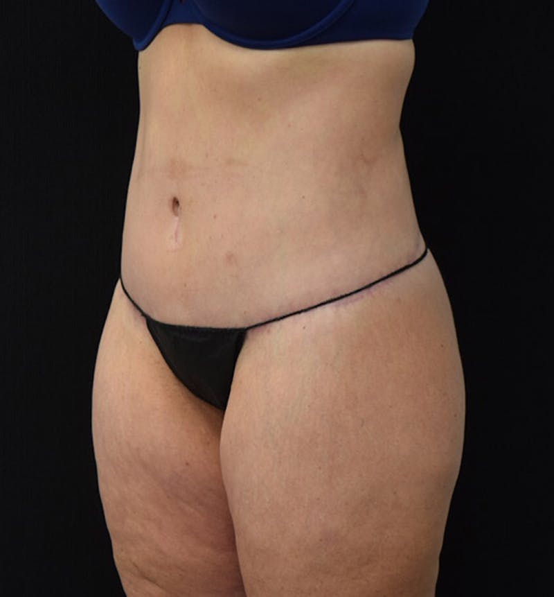 Lower Body Lift Before & After Gallery - Patient 102424241 - Image 8