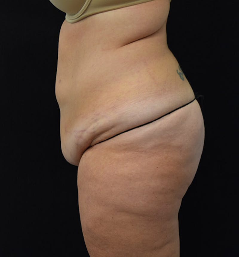 Lower Body Lift Before & After Gallery - Patient 102424241 - Image 9