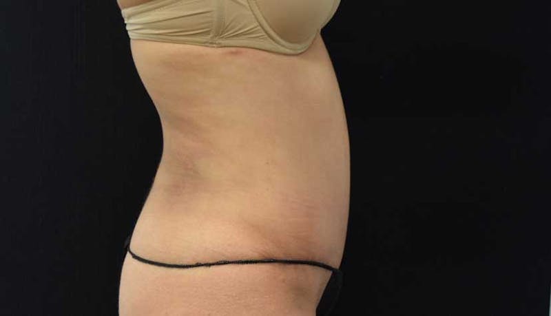 Abdominoplasty Before & After Gallery - Patient 102423917 - Image 8