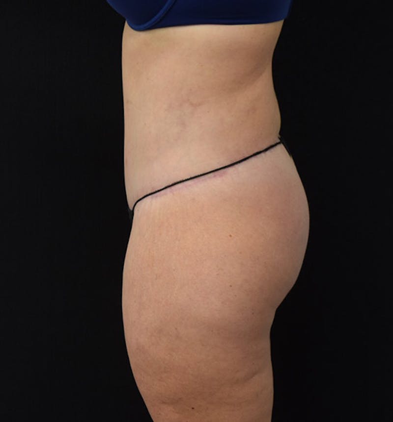 Lower Body Lift Before & After Gallery - Patient 102424241 - Image 10