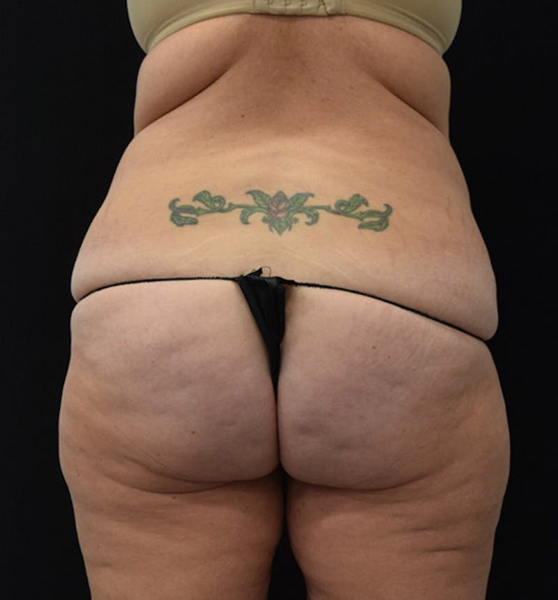 Lower Body Lift Before & After Gallery - Patient 102424241 - Image 11