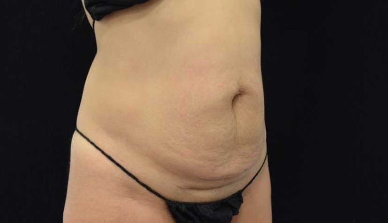 Abdominoplasty Before & After Gallery - Patient 102423917 - Image 9