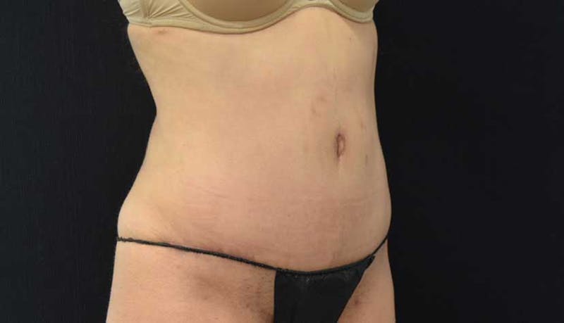 Abdominoplasty Before & After Gallery - Patient 102423917 - Image 10