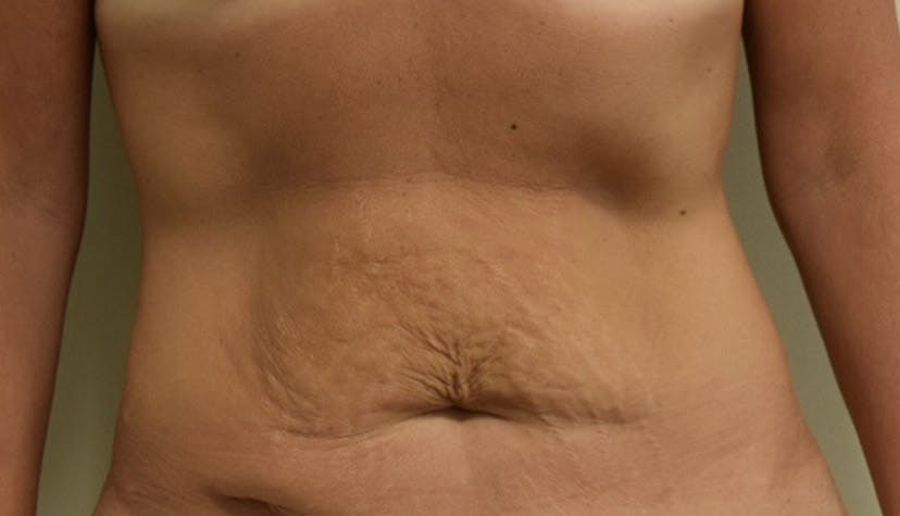 The Timeline of a Tummy Tuck Recovery According to One of Long Island's Top  Surgeons