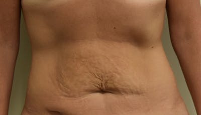 Abdominoplasty Before & After Gallery - Patient 102424251 - Image 1