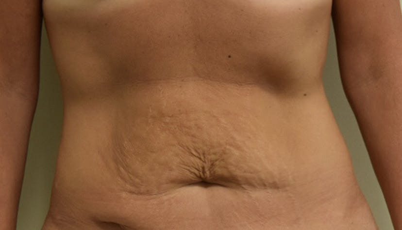 Tummy Tuck in Westchester, NY