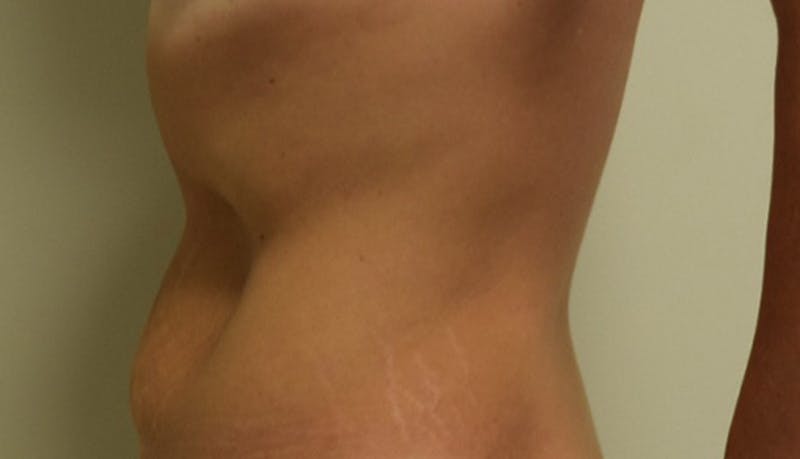 Abdominoplasty Before & After Gallery - Patient 102424251 - Image 3