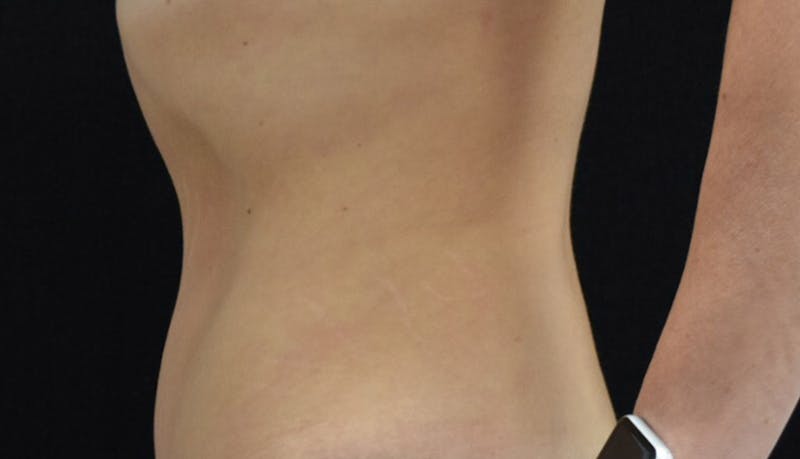 Abdominoplasty Before & After Gallery - Patient 102424251 - Image 4