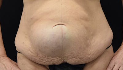 Massive Weight Loss Before & After Gallery - Patient 102425115 - Image 1