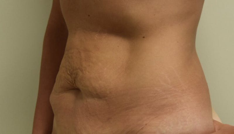 Abdominoplasty Before & After Gallery - Patient 102424251 - Image 5