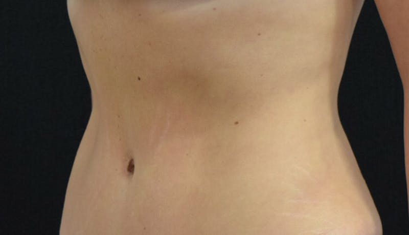 Abdominoplasty Before & After Gallery - Patient 102424251 - Image 6