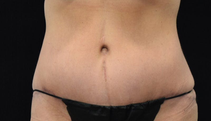 Massive Weight Loss Before & After Gallery - Patient 102425115 - Image 2
