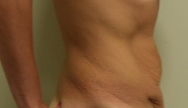 Abdominoplasty Before & After Gallery - Patient 102424251 - Image 7